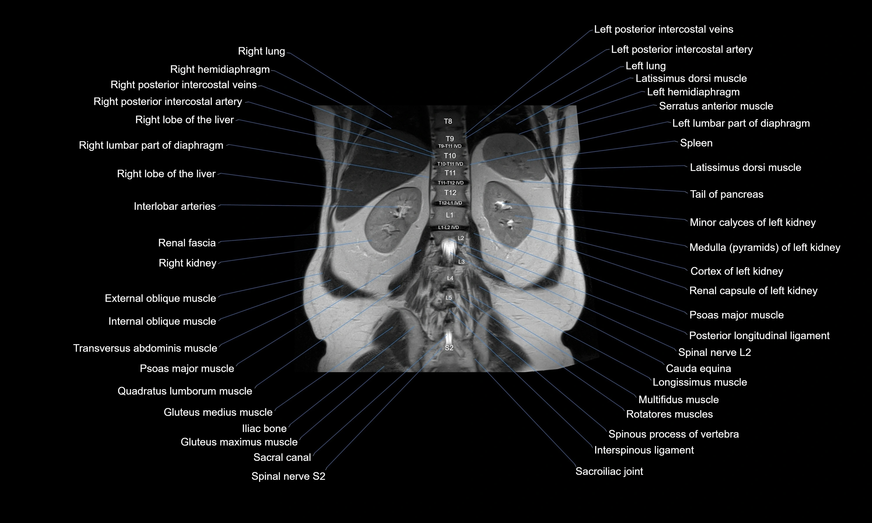 MRI Abdomen axial cross sectional anatomy radiology  image-img-00001-00043.webp